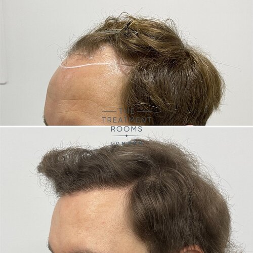 2037 Grafts Hairline and Crown Result- The Treatment Rooms London photo