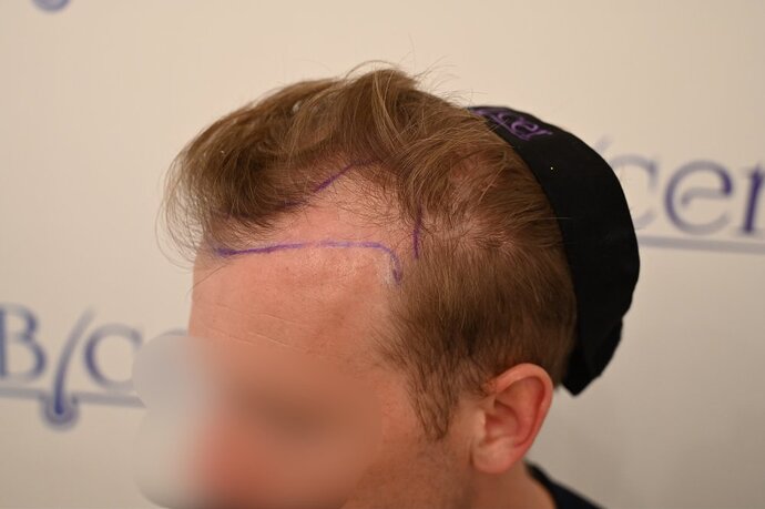 Ozlem Bicer MD-Hair Transplant-2720 Grafts FUE by micro-motor, 9. months result photo