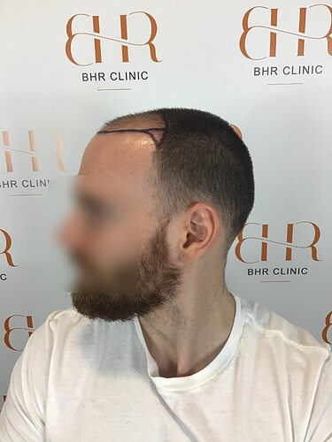 Dr. Kostis BHR Clinic Brussels - 2950 FUE 0 - 5 Months photo