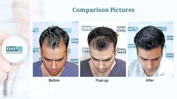 DHI India™ | NW 3 | 1,504 Grafts | 5 Months DHI Hair Transplant Results photo