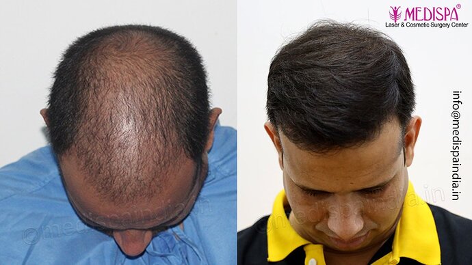 Dr. Suneet Soni - 4500 Grafts, Combine FUT + FUE Technique, NW-III photo