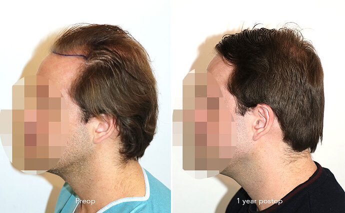 Case performed by Dr. Feriduni – 3322 FU in 1 procedure photo