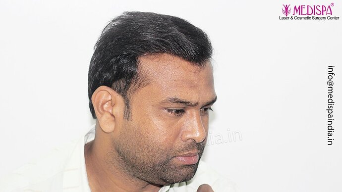 Dr. Suneet Soni - 5498 Grafts, 2 Years Result, Combine FUT + FUE + Beard Technique, NW-VI photo