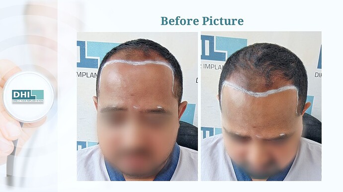 DHI India™ | NW 3 | 3,506 Grafts | 7 Months Hair Transplant photo