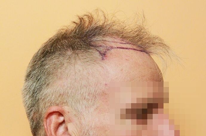 Dr. Bisanga - BHR Clinic / 3003 FUE - Frontal Case photo