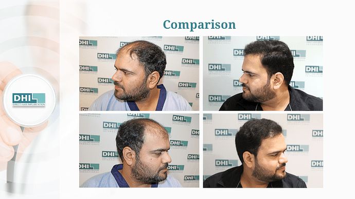 Full Scalp Coverage – 3511 Grafts | DHI India Result photo