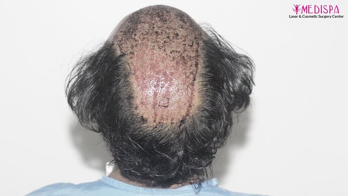 Revision Hair Transplant - 5111 Grafts / 5 Years Result - Dr. Suneet Soni, Medispa India photo