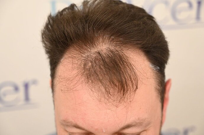 Ozlem Bicer MD-Hair Transplant-2910 Grafts FUE by micro-motor, 7. months result photo