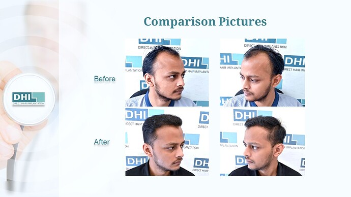 DHI India™ | NW 4 | 4,265 Grafts | 6-Months DHI™ Hair Transplant Results photo