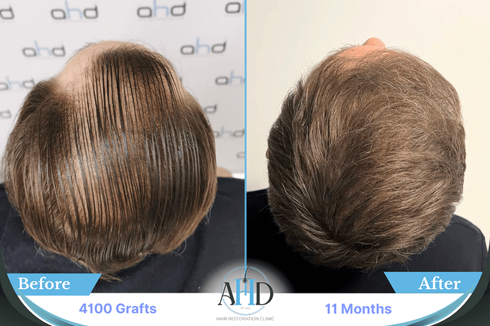 AHD Clinic Turkey - Hair Transplant Before & After Pictures - 4100 grafts - DHI photo