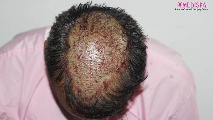 11600 Grafts in 3 FUT Sittings by Dr Suneet Soni photo