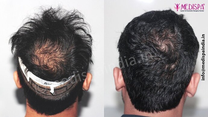 Dr. Suneet Soni - 5320 Grafts, Combine FUT + FUE Technique , NW- IV photo