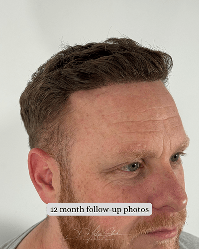 Dr Shah (London, UK) 3114 FUE grafts (0-12 months) photo