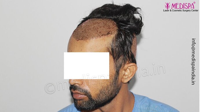 Dr. Suneet Soni - 3029 FUE Grafts, FUE Method (Trivellini System), NW - III photo