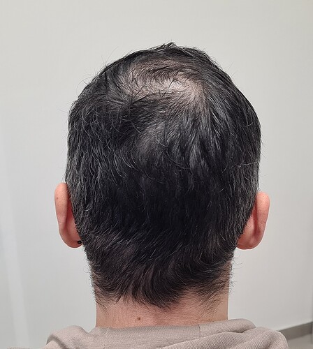 FUE Result for 4400 Grafts – 6 Months after – HDC Hair Clinic photo
