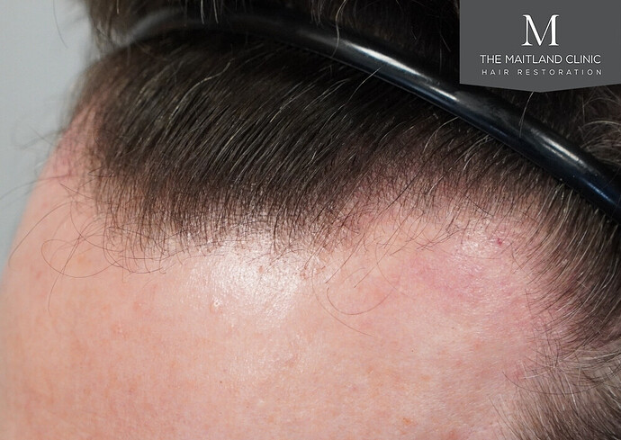 Before and after results: 1694 grafts by FUE at The Maitland Clinic (Dr Edward Maitland Ball) photo
