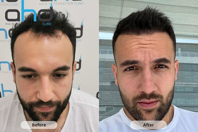AHD Clinic / Technicians / 4050 grafts / FUE + DHI photo