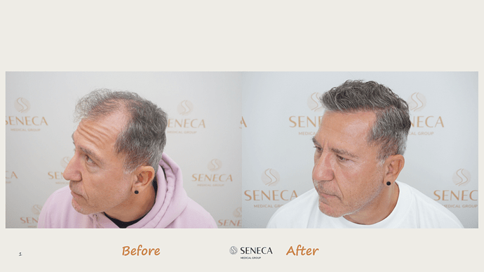 Seneca Medical Group - 3000 grafts with Direct Fue photo