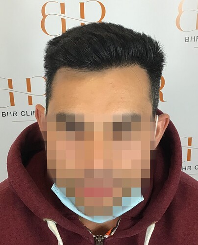 Dr. Bisanga BHR Clinic - 2350 FUE 0 – 12 Months with Photos and Video photo