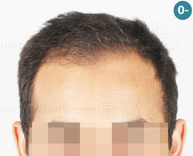 Dr Devroye + Dr Montesanti + Dr Jenard, HTS Clinic / 2018 FUE / Hairline & frontal area photo