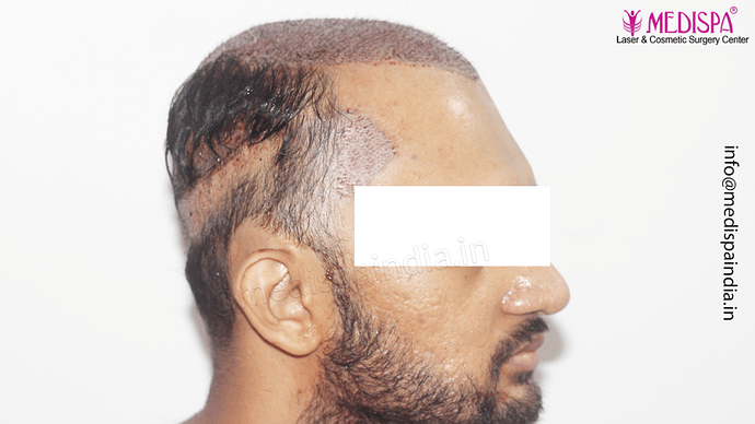 Dr. Suneet Soni - 4665 Grafts, Combine FUT + FUE + BHT (Beard) Technique photo