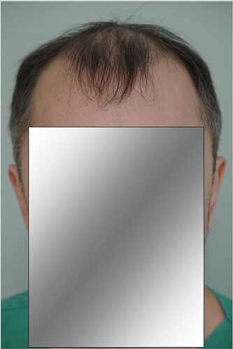 Hattingen Hair Clinic, 4 435: 4 093 FUT and 342 FUE. photo