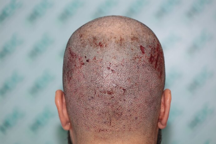 FUE Hair Transplant Result for 3100 Grafts - NW3 – 8 Months After – HDC Hair Clinic photo