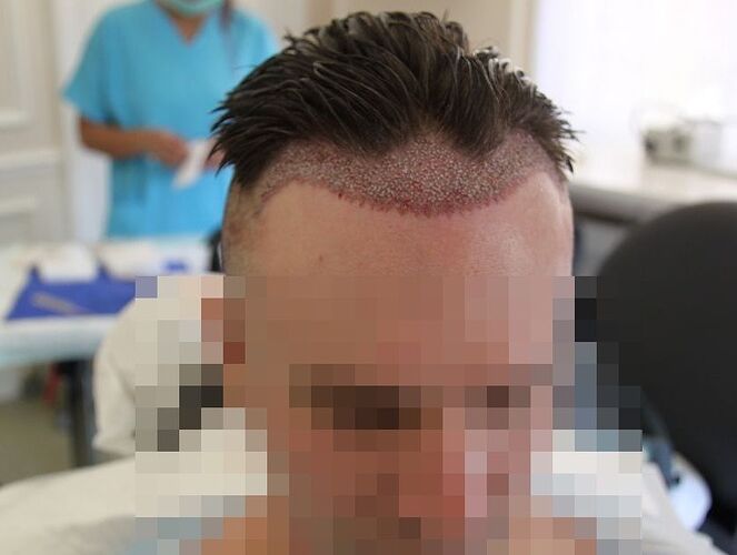 Dr.Bisanga, BHR Clinic, 1675 FUE, 0 - 13 Months photo