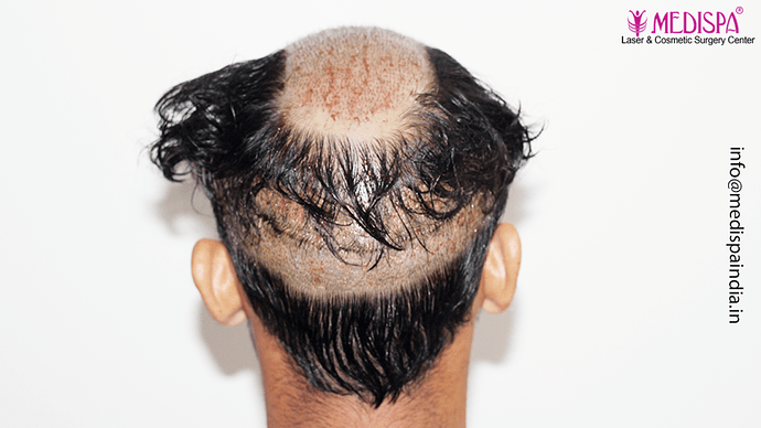 Dr. Suneet Soni - 4046 Grafts | 12-Month Result | Combination FUT + FUE + Beard photo