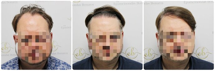 Dr Bonaros, Glasgow, UK / 3207 FUE grafts / 0-12 Months photo