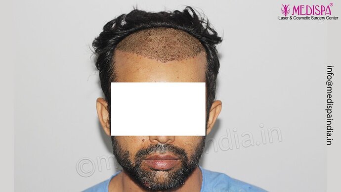 Dr. Suneet Soni - 3029 FUE Grafts, FUE Method (Trivellini System), NW - III photo