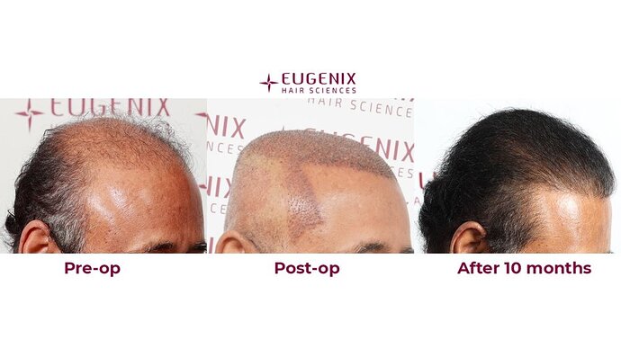 Eugenix Hair Sciences| NW 7 | 6309 Grafts | 10 Months Post-op| Dr. Pradeep Sethi photo