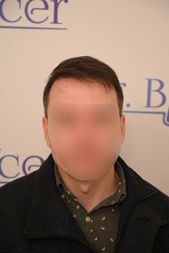 Ozlem Bicer MD-Hair Transplant-3980 Grafts FUE by micro-motor, 12. months result photo