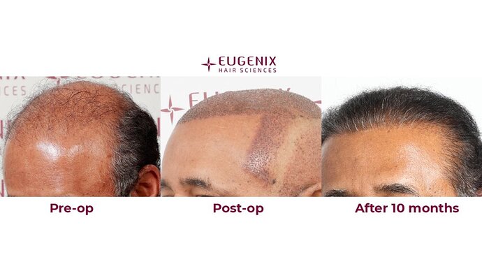 Eugenix Hair Sciences| NW 7 | 6309 Grafts | 10 Months Post-op| Dr. Pradeep Sethi photo