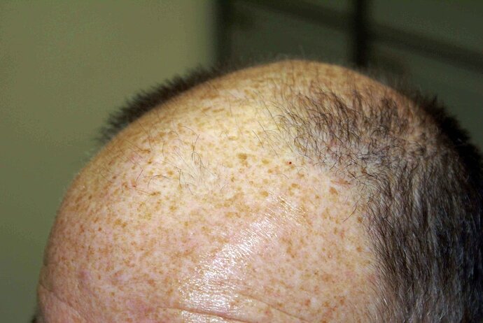 Dr B Farjo 2000-2023 Patient using both FUT and FUE, photo