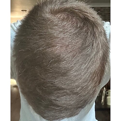 Dr. Bisanga & Dr. Kostis - 2955 FUE - 9 Months - Front & Crown photo