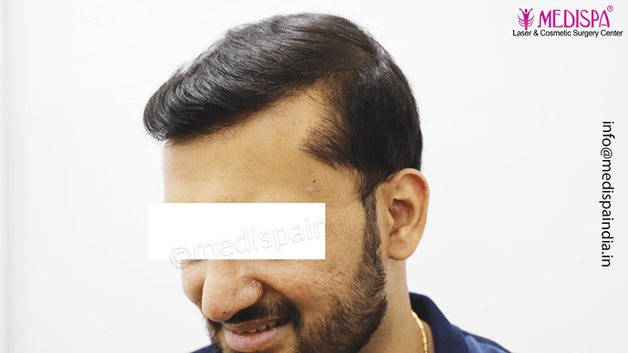 Dr. Suneet Soni - 4665 Grafts, Combine FUT + FUE + BHT (Beard) Technique photo