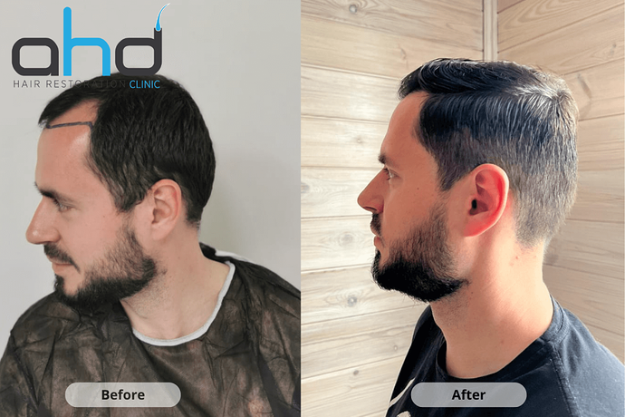 AHD Clinic / Dr.Hakan Doganay's Team / 4300 grafts / DHI + FUE photo