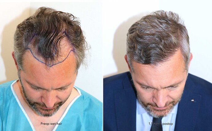 Case performed by Dr. Feriduni – 3242 FU in 1 procedure photo