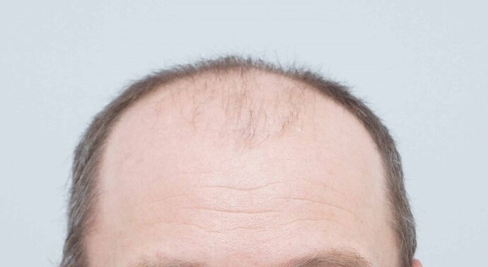 Dr B Farjo - FUE - 2091 Grafts photo