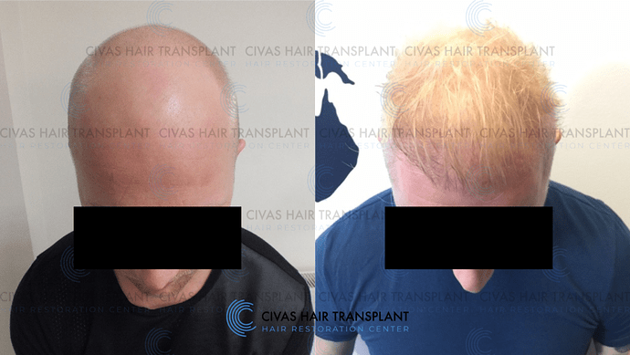 Civas Hair Transplant- FUE Hair Transplant Before & After Pictures (3500 Grafts) photo