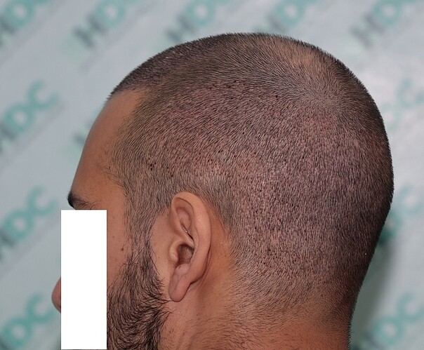 Result of 4000 grafts – 11 months after – NW class 4 photo