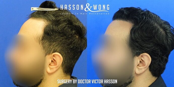 Dr. Hasson / 2,500 grafts / FUE / Hairline / 1 Year Post-op photo