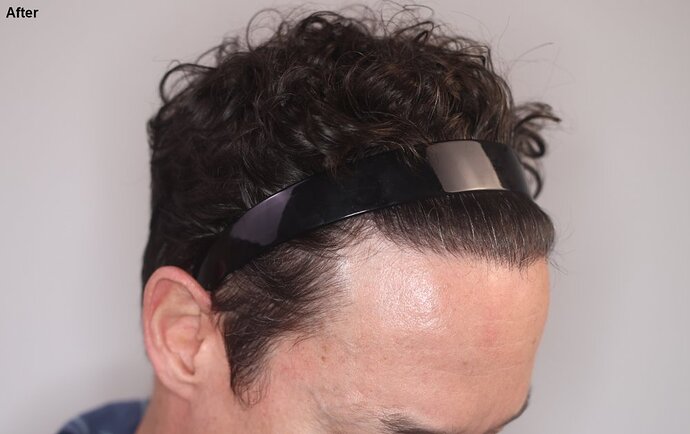 Dr. Ischayek hair restoration result - 1,075 grafts alviarmani photo