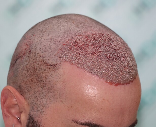 Result of NW3 patient after 3230 grafts after 7 months – HDC Hair Clinic – Dr Christina photo