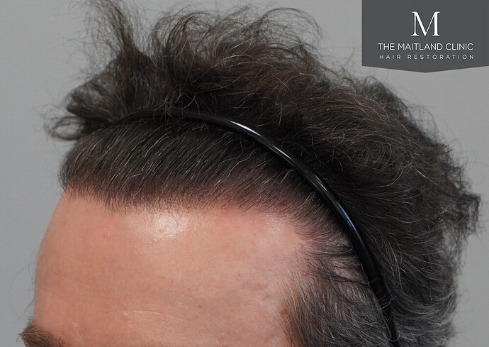 Before and after results: 1694 grafts by FUE at The Maitland Clinic (Dr Edward Maitland Ball) photo