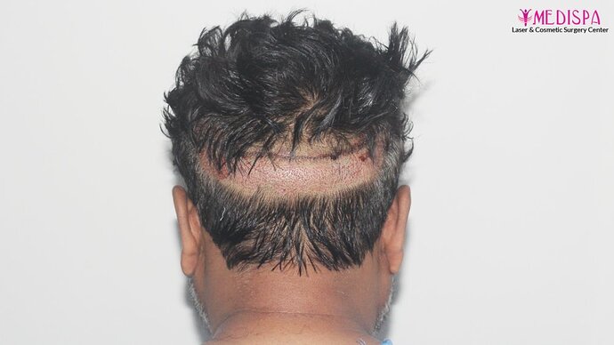 Dr. Suneet Soni - 4190 Grafts, Combine FUT + FUE + Beard Technique, NW- III photo