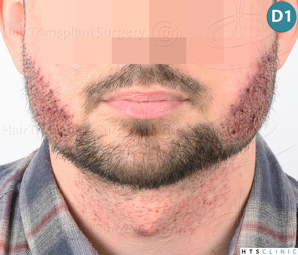 Dr. Jean Devroye, HTS Clinic / 1523 FUE / Beard to beard restoration photo