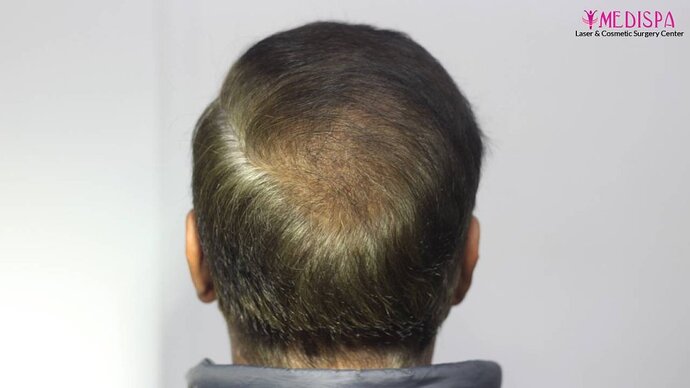 11600 Grafts in 3 FUT Sittings by Dr Suneet Soni photo