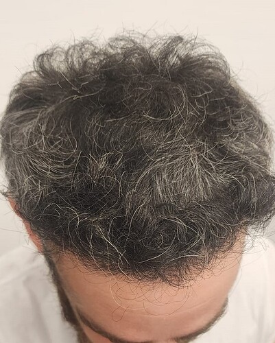 Result of Class 3V Patient – 3530 Grafts – HDC Hair clinic – Dr Maras photo